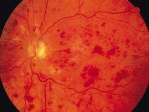 糖尿病性视网膜病变如何?